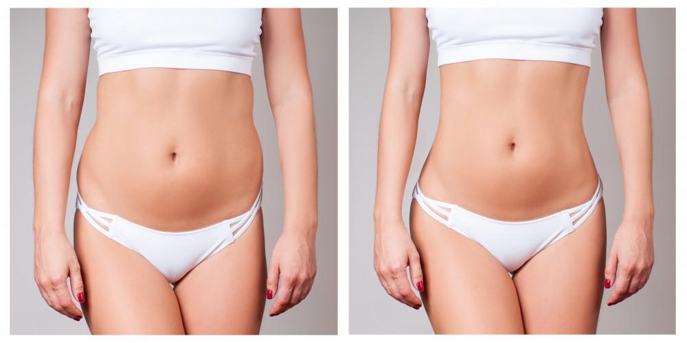 transforming your body with liposuction how to know if you are a good candidate 5e2b27dd924b5