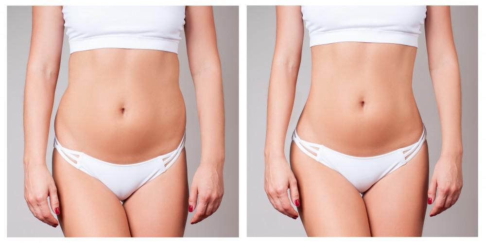 Why More Women Than Ever Are Choosing Brazilian Butt Lifts!