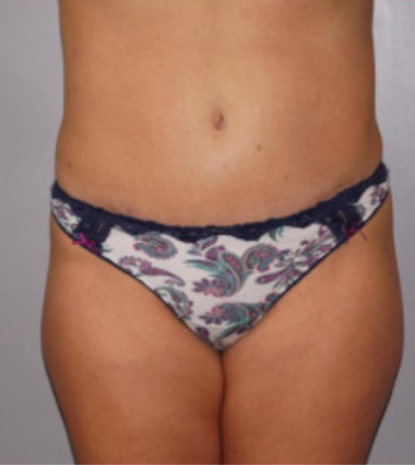 Liposuction After