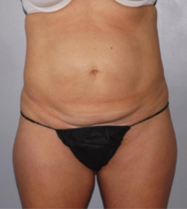 Liposuction Before