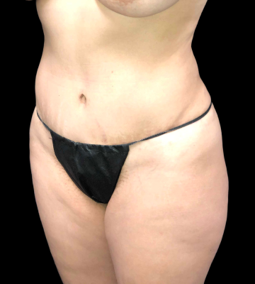 Tummy_Tuck_01_left_oblique_after