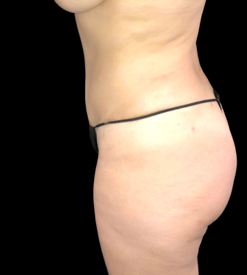 Tummy_Tuck_01_left_side_after