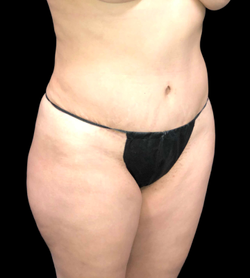 Tummy_Tuck_01_right_oblique_after