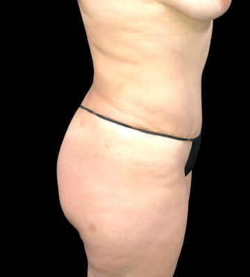 Tummy_Tuck_01_right_side_after