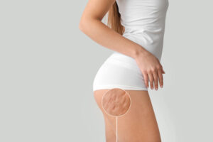 Young woman with cellulite problem 1