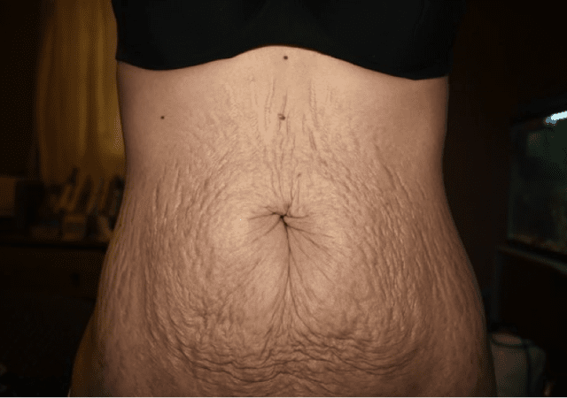 how to avoid a tummy tuck a public service announcement from providence plastic surgery 5e2b28a78ac17 1