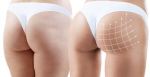safe and state of the art bbl at providence plastic surgery 5e2bce4 1